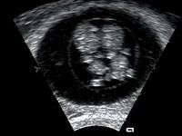 nasterea anatomia unui miracol vitro inca multe implica riscuri serioase. tot stiinta insa capabila Astrolog